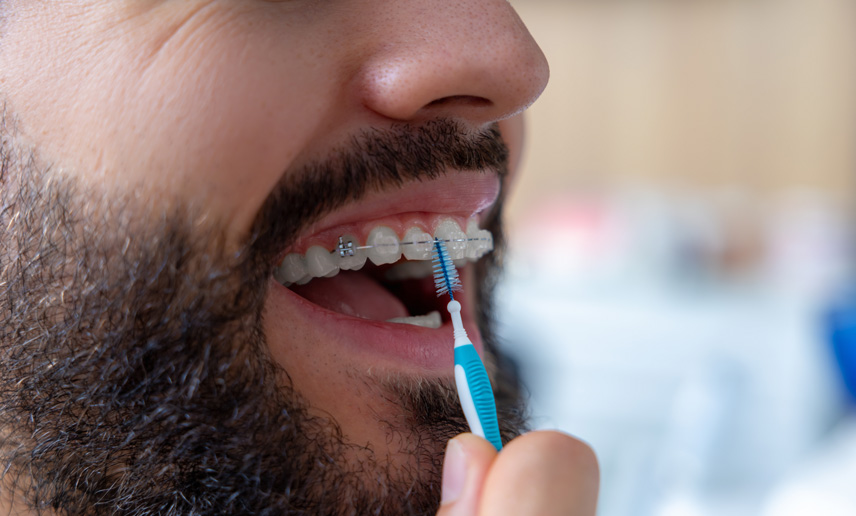 Clear vs metal braces: Which is right for you?
