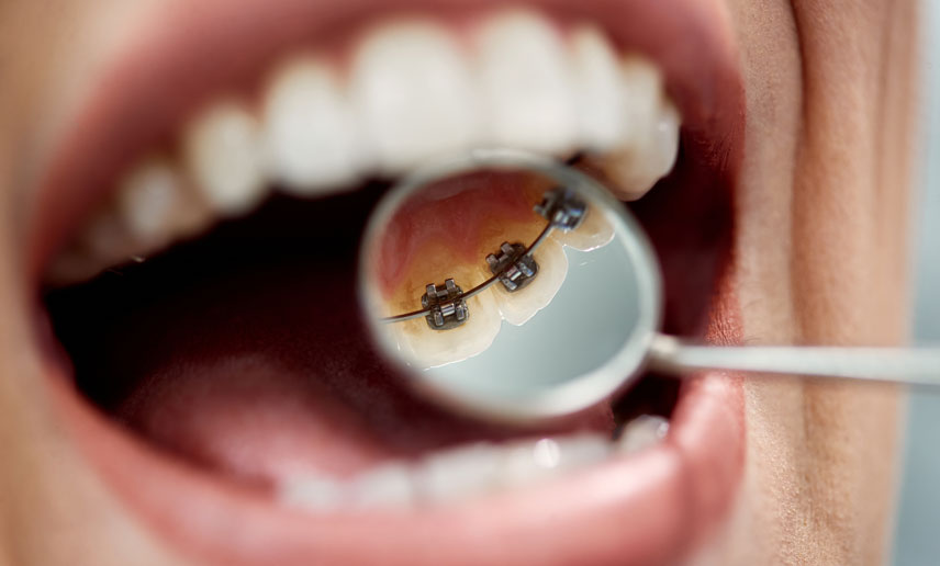 Are There Braces That Go Behind Your Teeth? Are There Braces That Go Behind Your Teeth?
