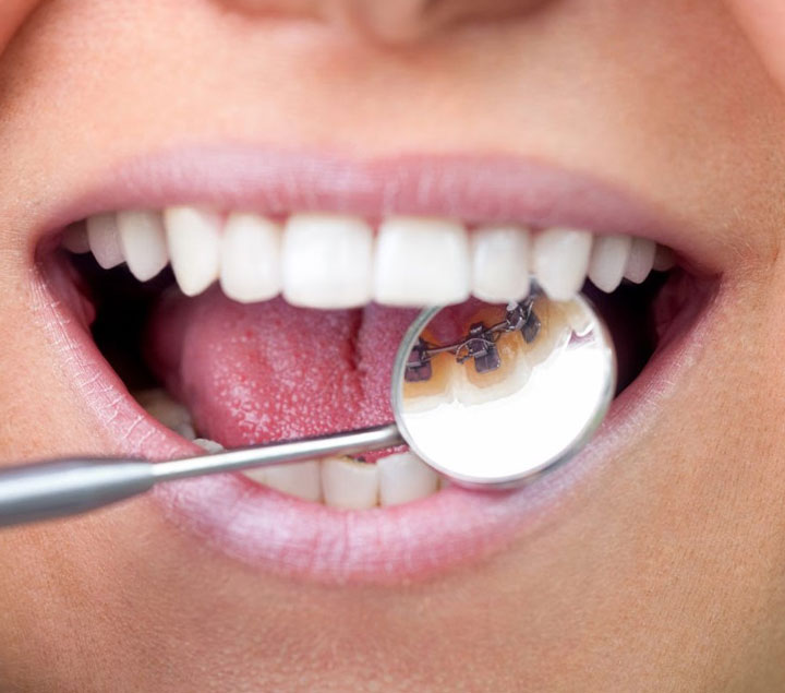 What are lingual braces? What are lingual braces?