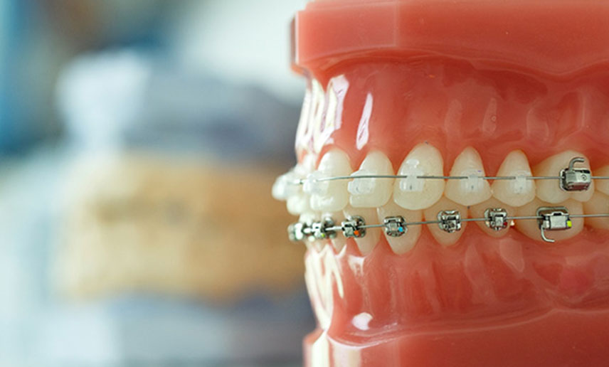 How Much Do Braces Cost In Queensland? Your Guide To Affordable Smiles